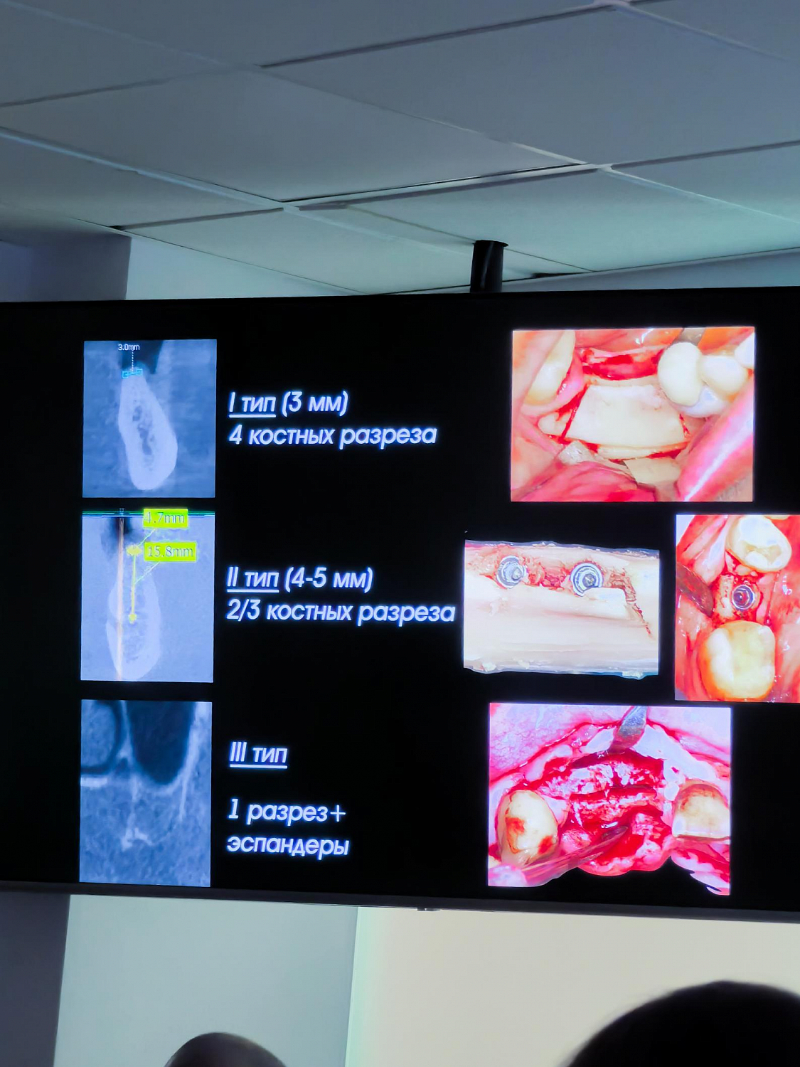 Два дня глубокой практики по костной пластике и синус-лифтингу