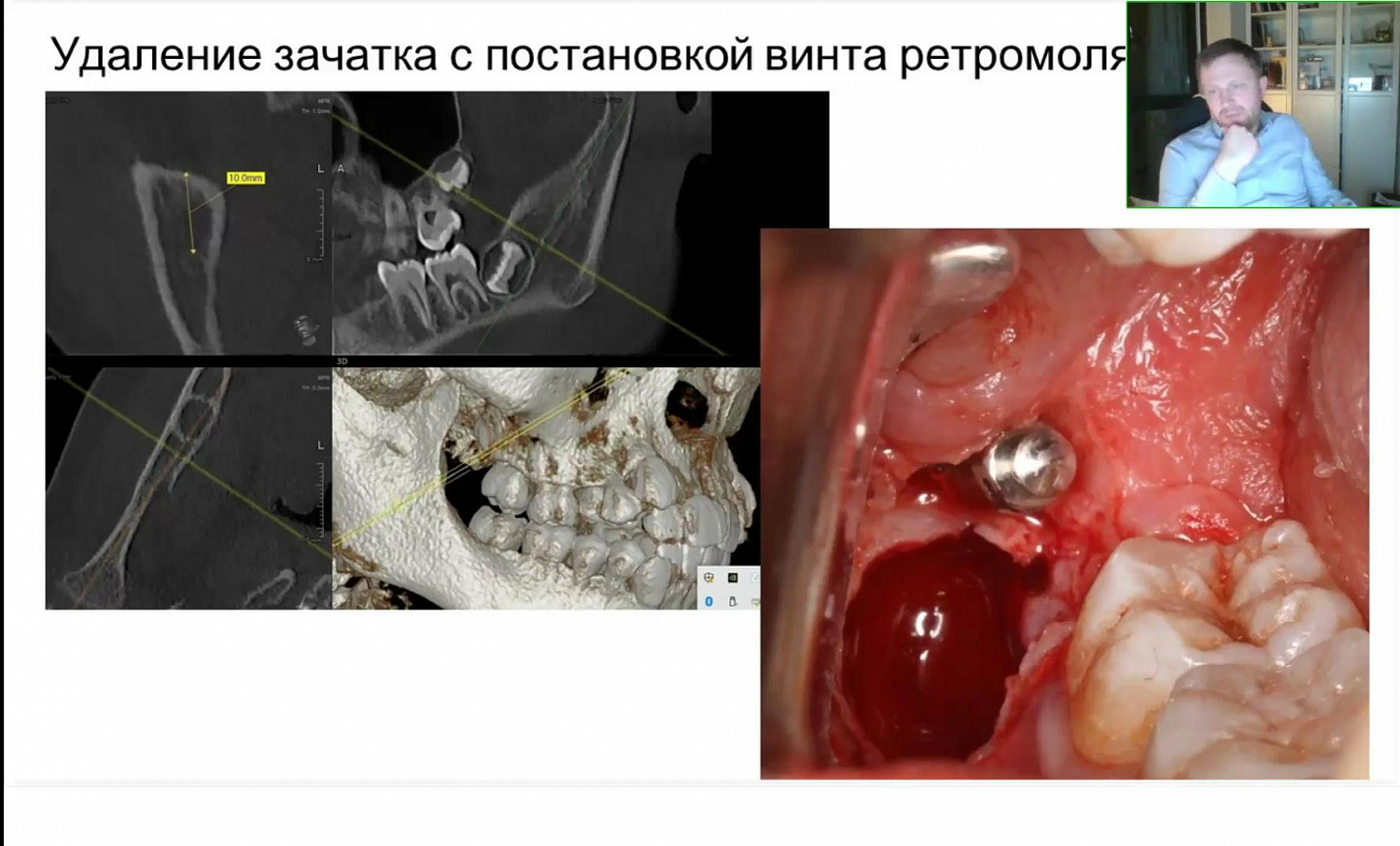 Буду резать, буду шить! 6 видов разрезов и швов в практике хирурга-стоматолога