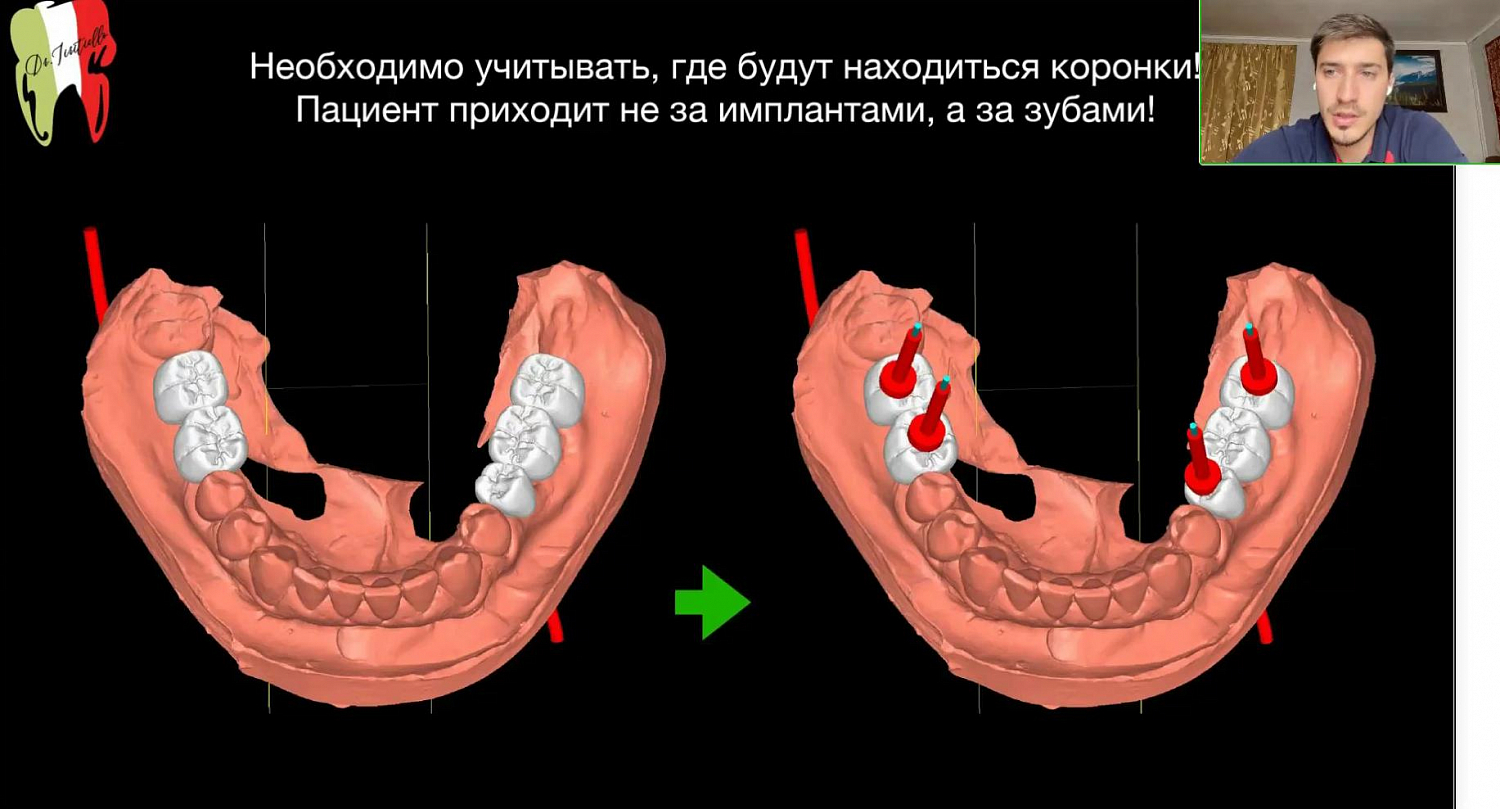 Распространенные ошибки и осложнения при ортопедическом лечении на дентальных имплантатах