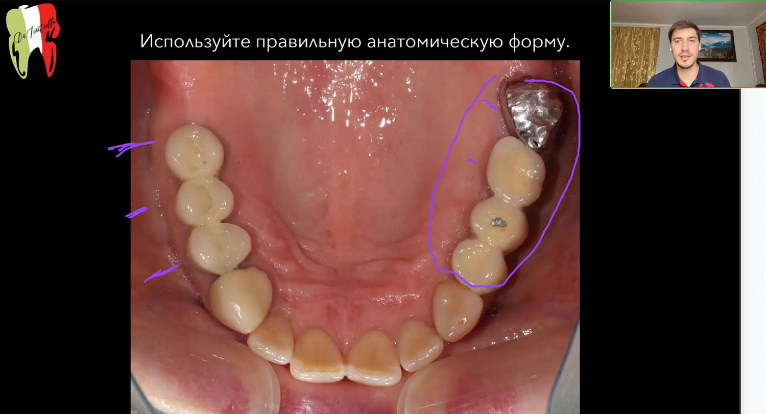 Распространенные ошибки и осложнения при ортопедическом лечении на дентальных имплантатах