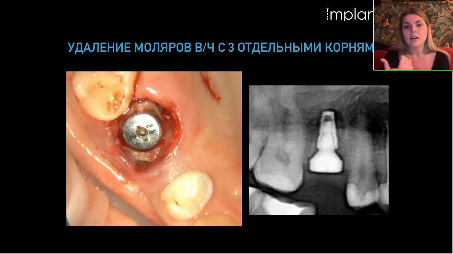 Тактика малотравматичного удаления зубов при одномоментной имплантации