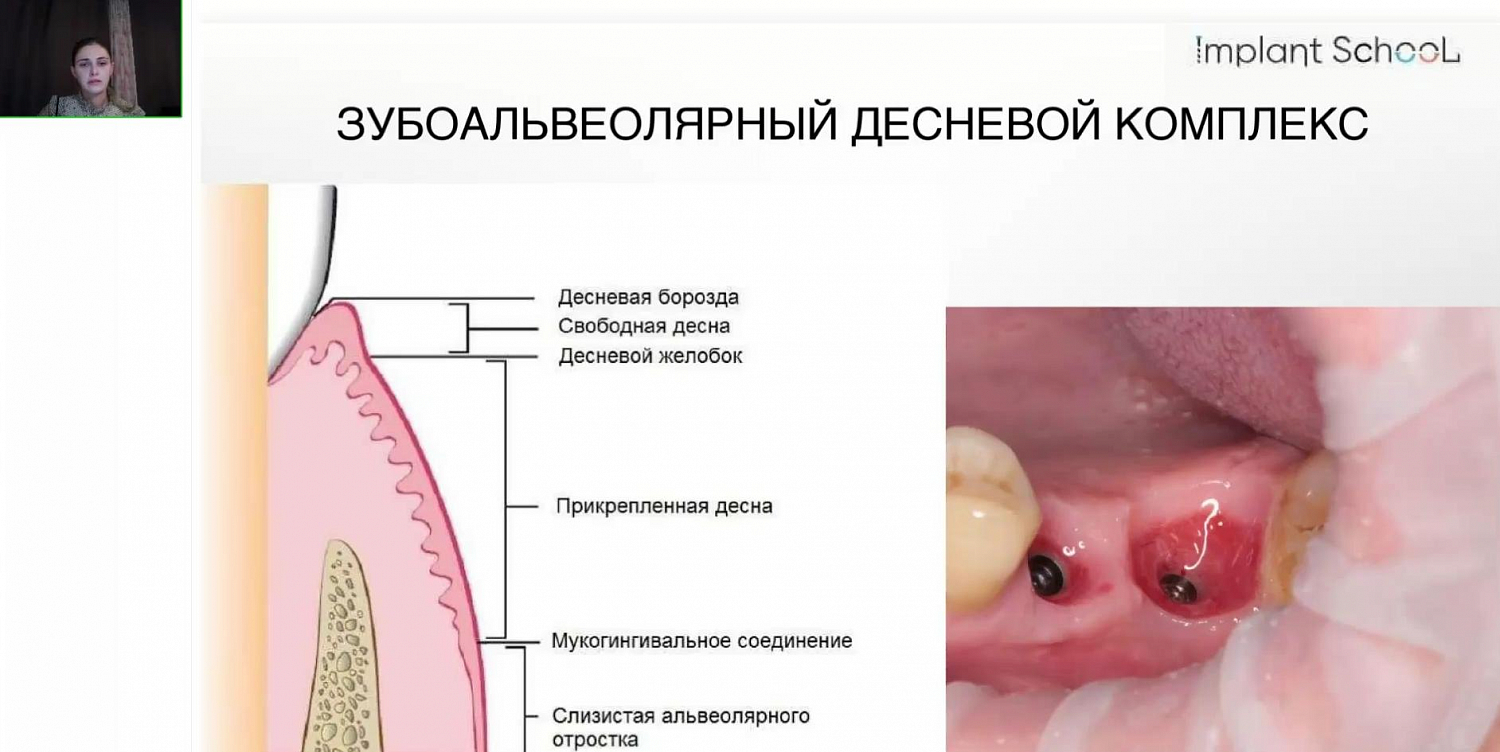 Методики увеличения объёма мягких тканей на этапе установки формирователя десны