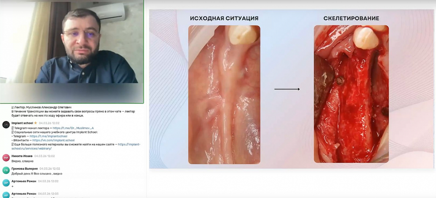 Ламинатная техника и НКР: как выбрать методику костной пластики под конкретного пациента